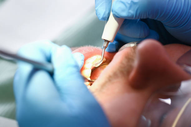 Best Emergency Wisdom Teeth Removal in Athens, IL